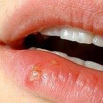 cold sore