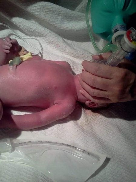 premature birth 