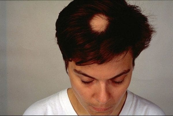 Alopecia Male Pattern Baldness by North Carolina lifestyle blogger Adventures of Frugal Mom