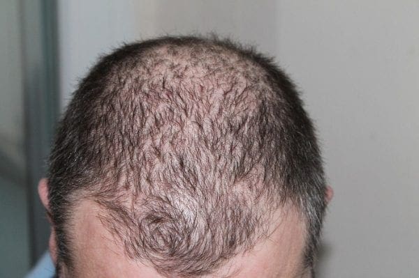 Male Pattern Baldness by North Carolina lifestyle blogger Adventures of Frugal Mom