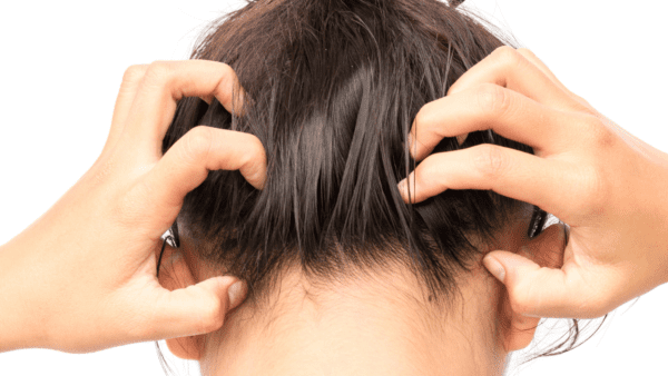 Reasons to Avoid Scalp Sunburns from North Carolina Lifestyle Blogger Adventures of Frugal Mom