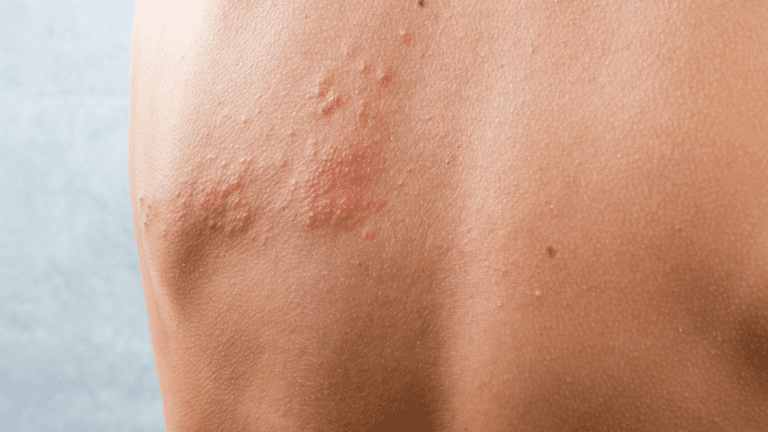 Expert Advice: Managing Chafing Rash with Professional Guidance