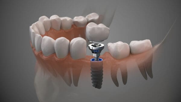 From Consultation To Recovery: How Long Do Dental Implants Take?