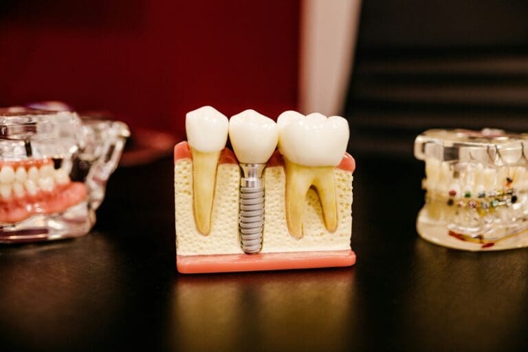 Understanding Dental Implants: Benefits, Procedure, and Aftercare