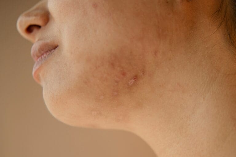 Beauty Insights: What a Dermatologist Can Do for Acne-Prone Skin