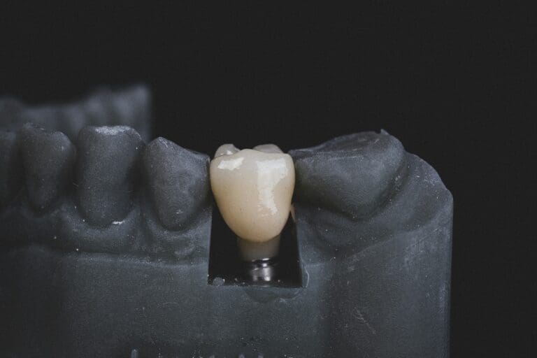 Essential Considerations Before Opting for Full Mouth Dental Implants