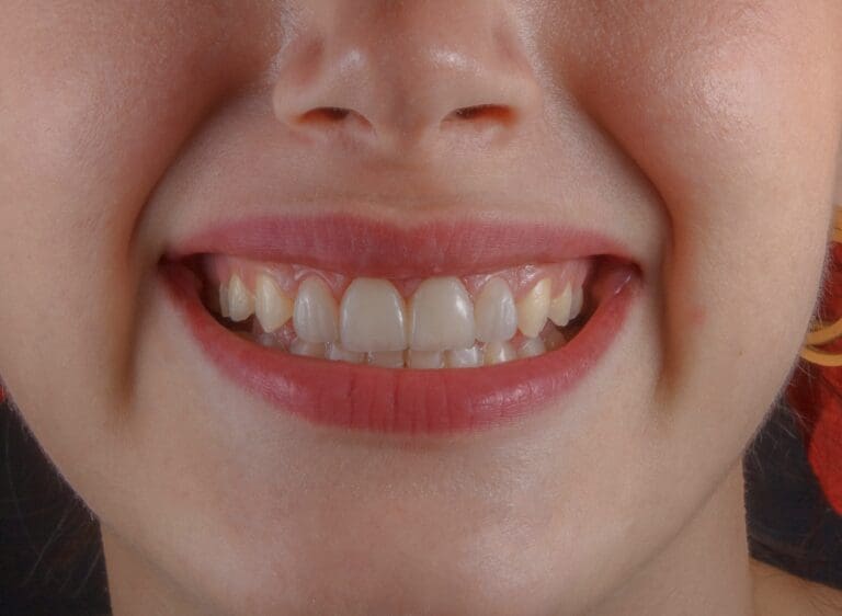 Why Healthy Gums Are The Foundation Of Successful Implant Dentistry