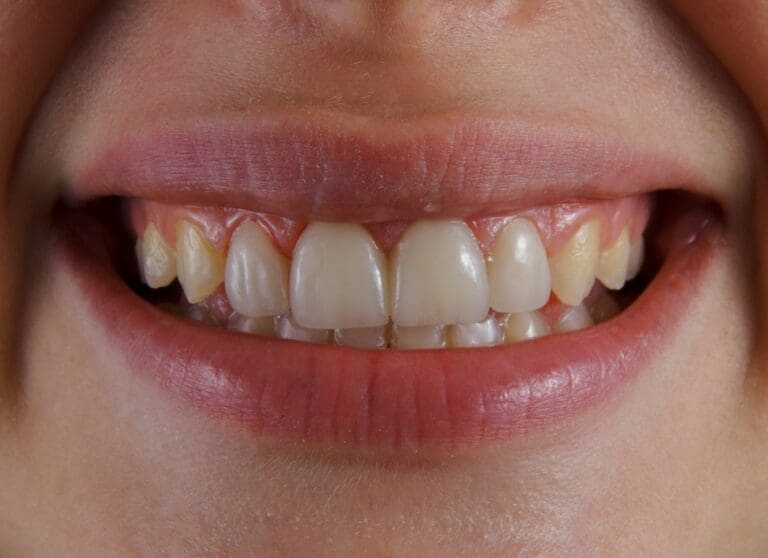 Why Bleeding Gums Shouldn’t Be Ignored