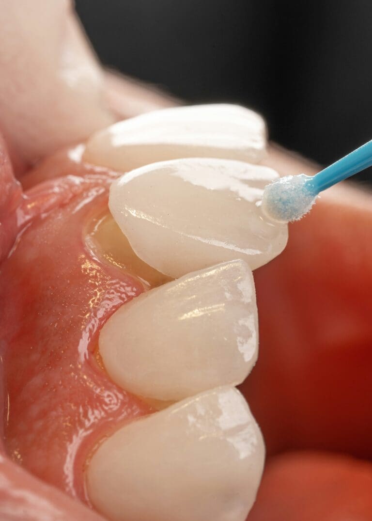 What to Know Before Getting Porcelain Veneers in Miami